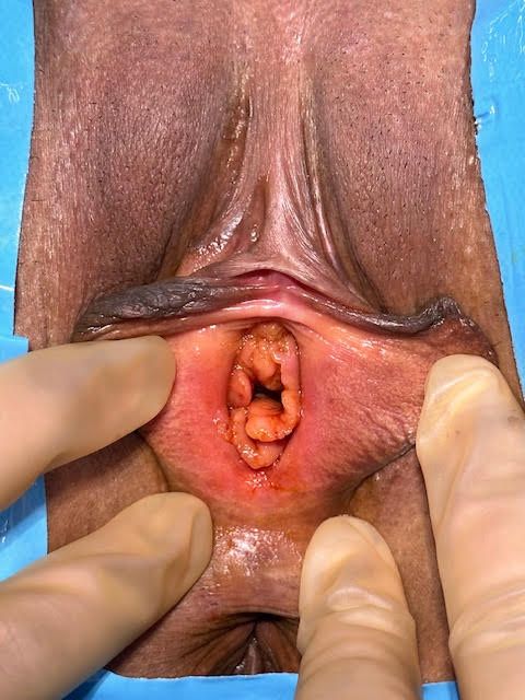 Hymenoplasty Before & After