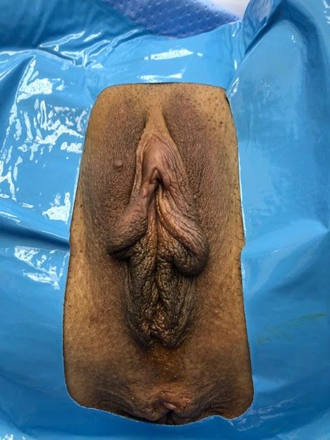 Vaginoplasty Before & After